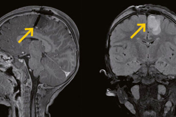 Developments in Neuroradiology for Epilepsy Evaluation