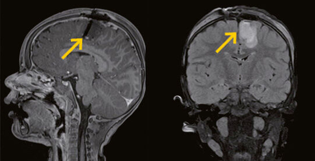 Developments in Neuroradiology for Epilepsy Evaluation