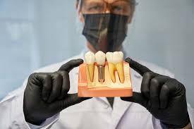 Frequently Asked Questions About Dental Implants