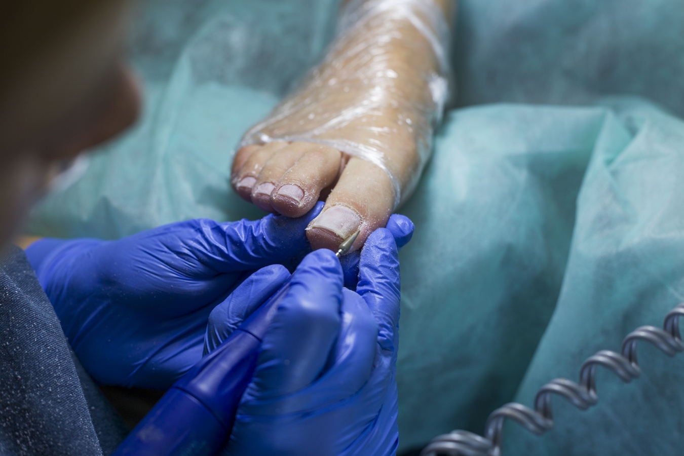 How Ingrown Toenails Can Affect Your Overall Foot Health