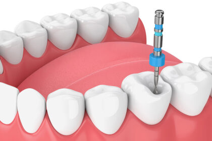 How to Recognize the Signs of Infection After a Root Canal