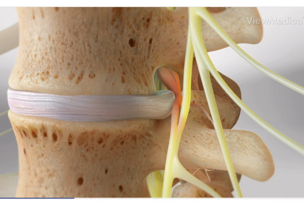 The Advancements in Disc Replacement Surgery Techniques