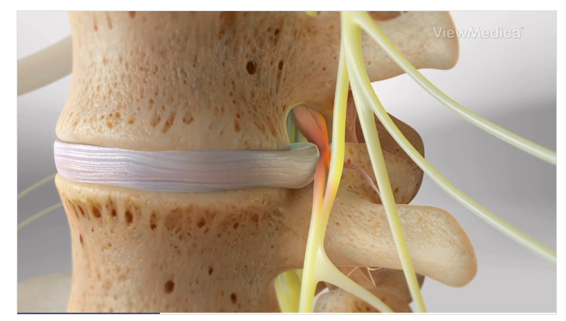 The Advancements in Disc Replacement Surgery Techniques