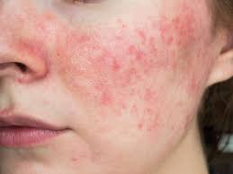 The Role of a Dermatologist in Managing Rosacea