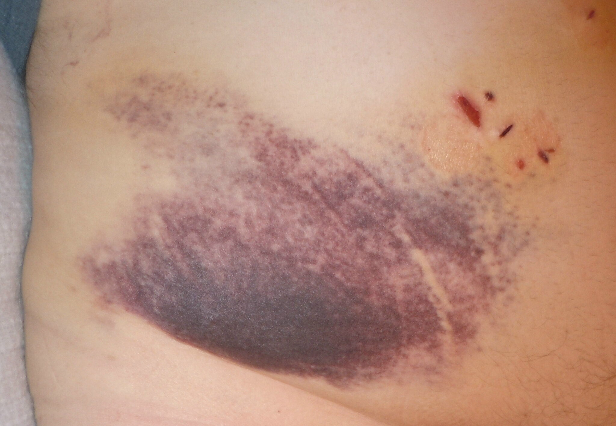 The Impact of Gallbladder Surgery on Digestive Health