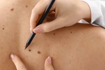 When to See a Skin Doctor for Unusual Moles or Skin Changes