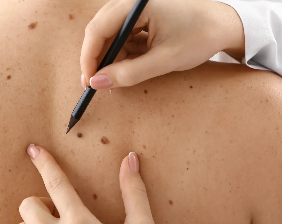 When to See a Skin Doctor for Unusual Moles or Skin Changes