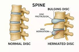 4 Degenerative Disc Disease Treatments