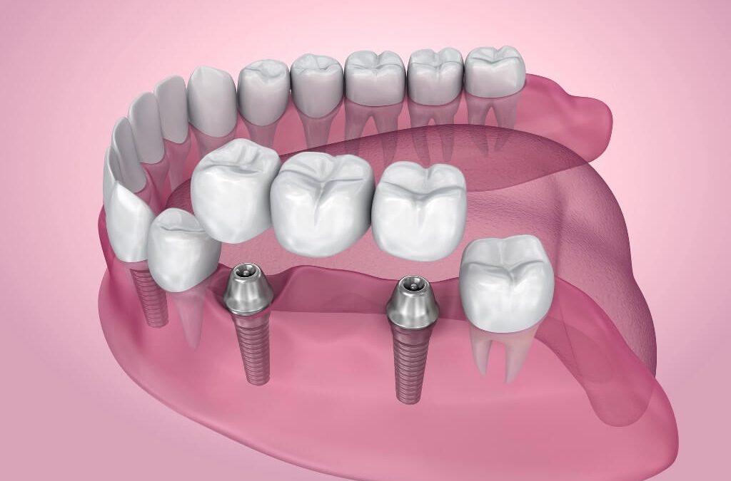 A Closer Look at the Benefits of All-on-4 Dental Solutions