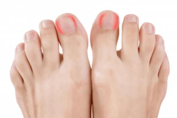Effective Strategies for Treating Ingrown Toenails