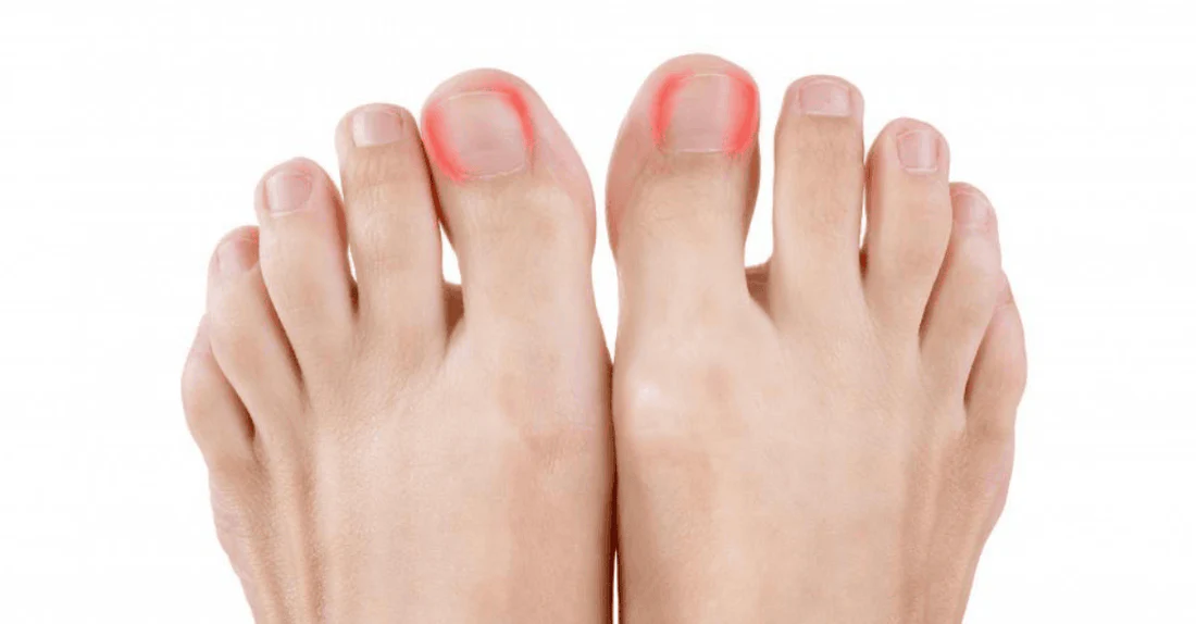Effective Strategies for Treating Ingrown Toenails