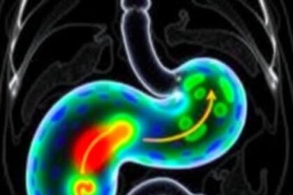 Exploring Advances in Pancreatic Cancer Treatment