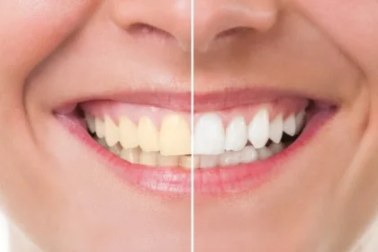 How Teeth Whitening Works and What To Expect