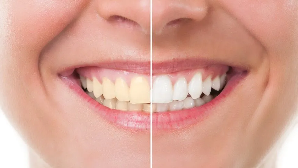 How Teeth Whitening Works and What To Expect