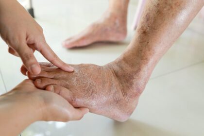 How a Podiatrist Can Help Manage Diabetes-related Foot Issues