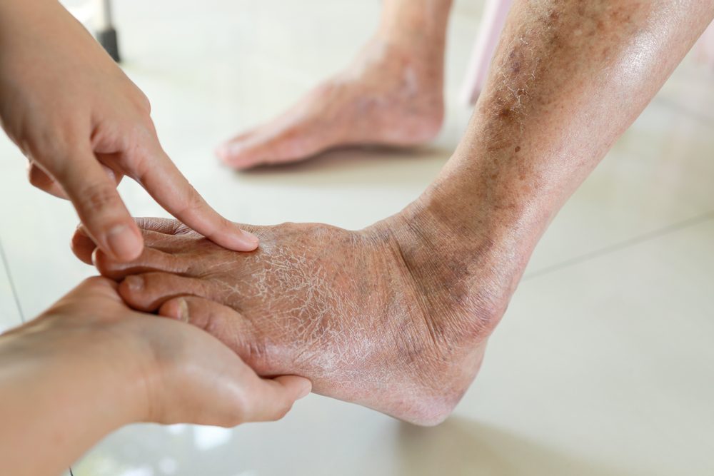 How a Podiatrist Can Help Manage Diabetes-related Foot Issues