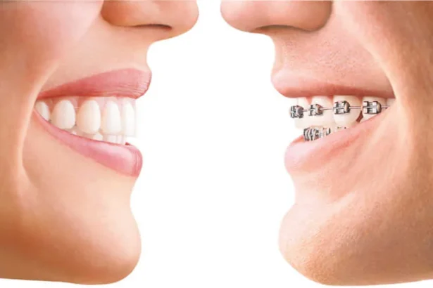 Invisalign vs Traditional Braces
