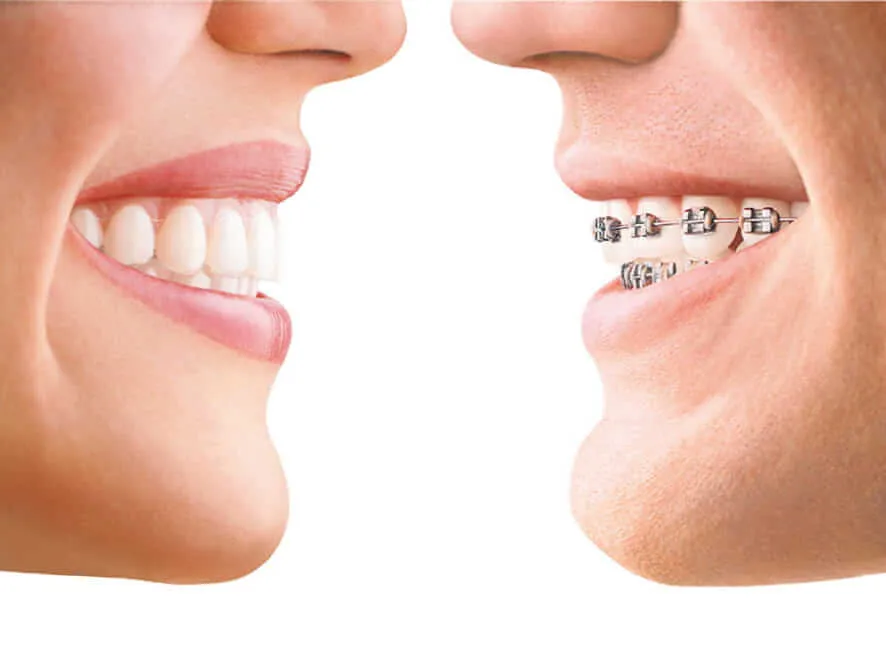 Invisalign vs Traditional Braces