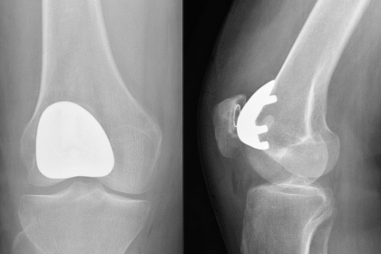 The Impact of Robotic Joint Replacement on Recovery Times
