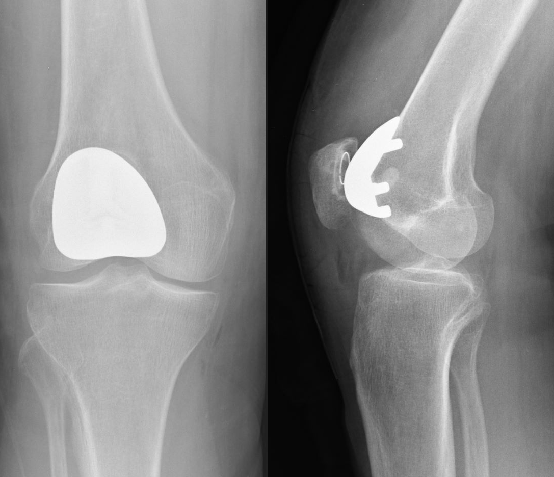 The Impact of Robotic Joint Replacement on Recovery Times