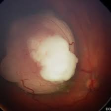 The Role of Eye Injections in Treating Retinal Vein Occlusion