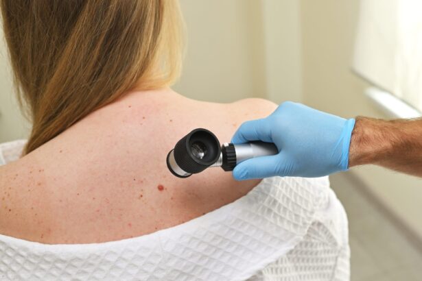 The Role of a Melanoma Dermatologist in Early Detection