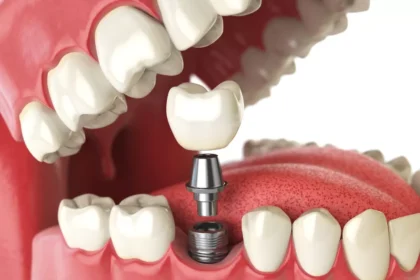 Understanding the Benefits and Types of Dental Implants