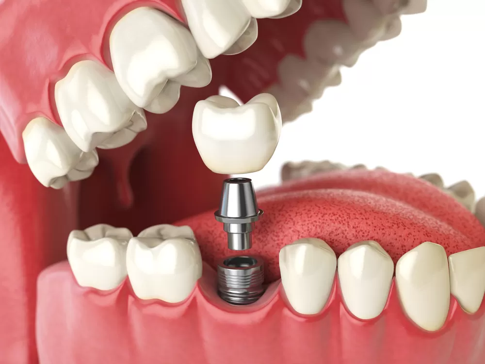 Understanding the Benefits and Types of Dental Implants