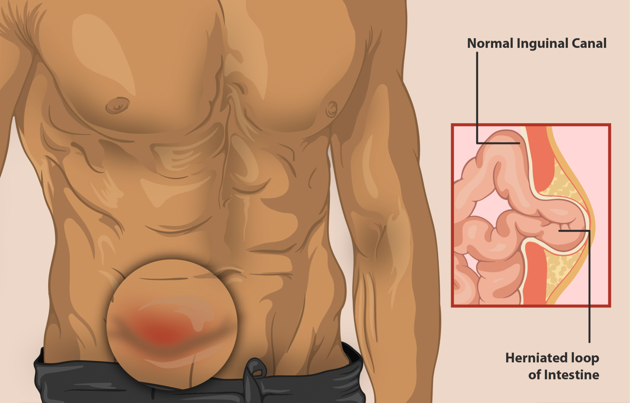 Understanding the Different Types of Hernias