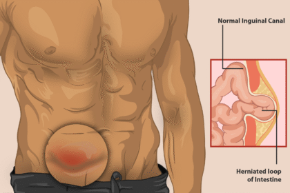 Understanding the Different Types of Hernias