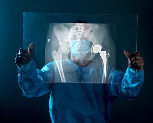 Understanding the Recovery Process After Hip Replacement Surgery