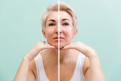 What To Know About Rosacea