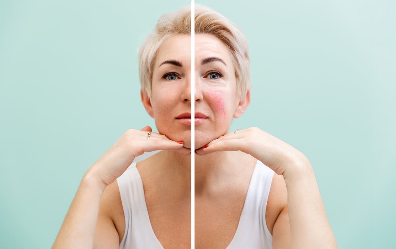 What To Know About Rosacea