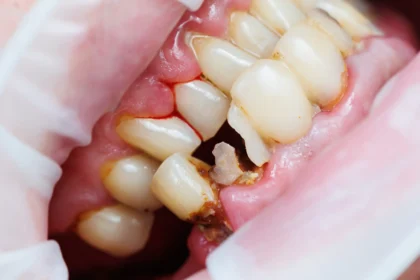 What to Do if You Have a Broken Tooth