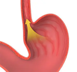 Understanding GERD and How a Gastroenterologist Can Help
