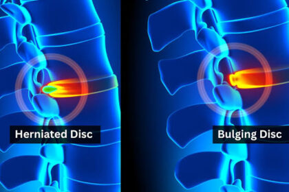 Understanding the Anatomy of a Herniated Disc