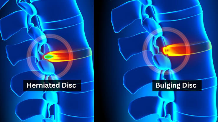 Understanding the Anatomy of a Herniated Disc