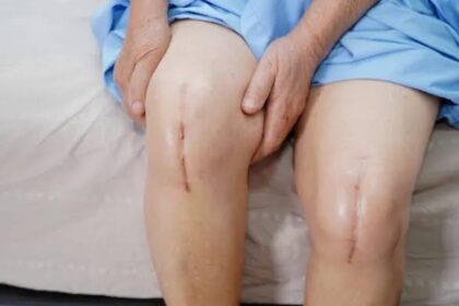 Understanding the Recovery Process After Knee Replacement
