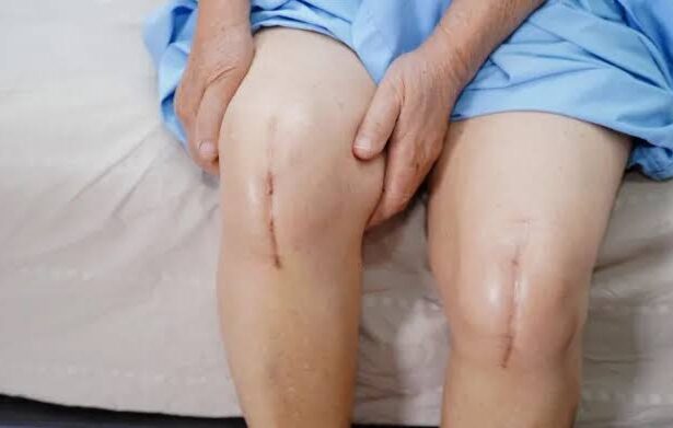 Understanding the Recovery Process After Knee Replacement