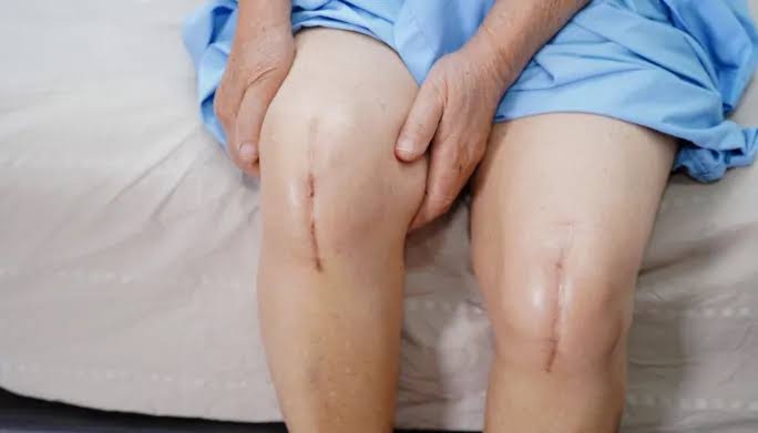 Understanding the Recovery Process After Knee Replacement