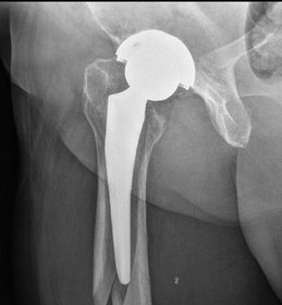 What To Know About Hip Arthroplasty From an Orthopedic Surgeon