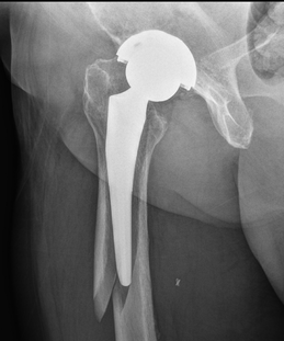What To Know About Hip Arthroplasty From an Orthopedic Surgeon