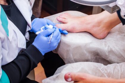 Why Podiatrists Are Key for Ingrown Toenail Removal