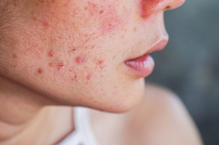 Helpful Things To Know About Acne Treatment
