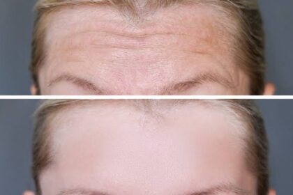 Is Botox a Preventative Treatment or Quick Fix?