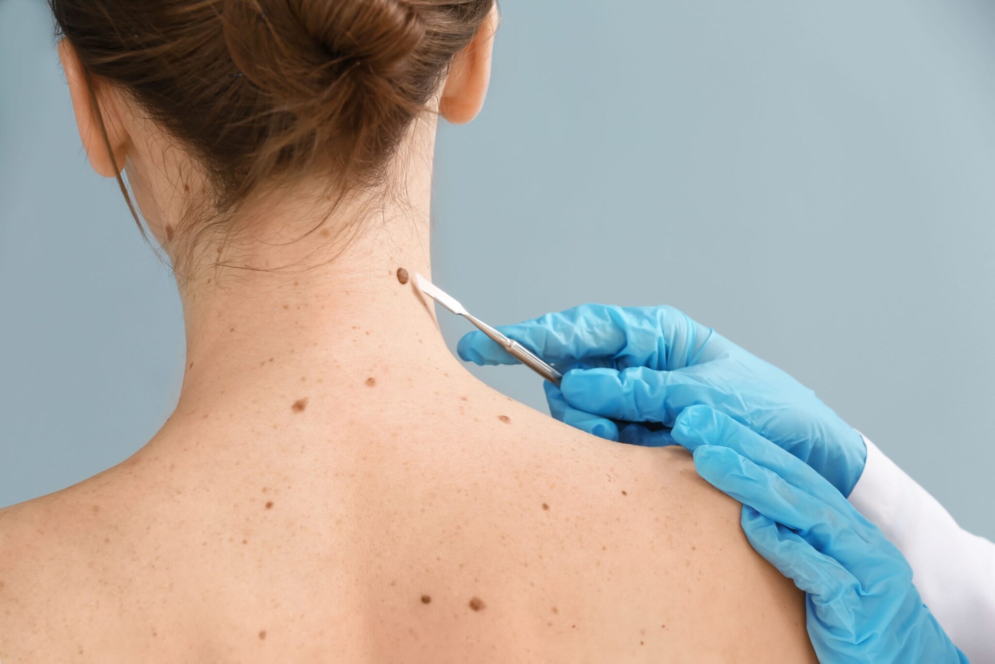 Melanoma Prevention and Sun Safety Tips