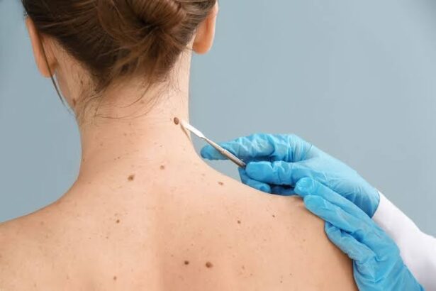 What To Expect From Professional Skin Tag Removal