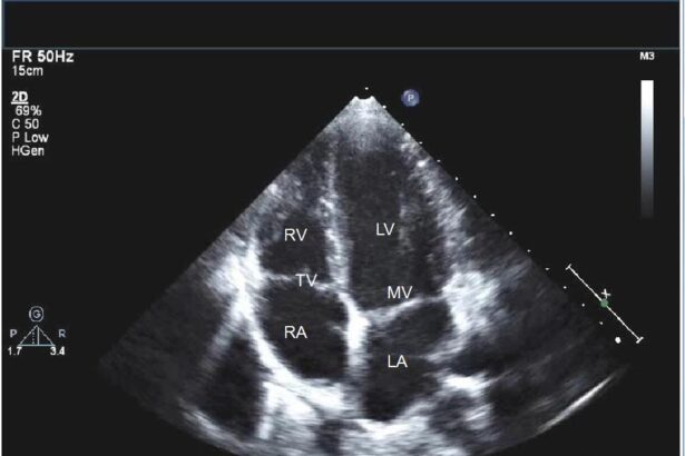 What To Expect From an Echocardiogram