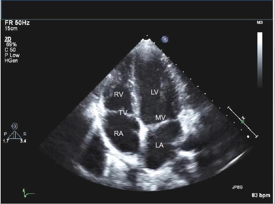 What To Expect From an Echocardiogram