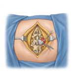 What To Know About Hernias